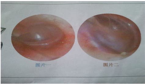 中耳炎图片