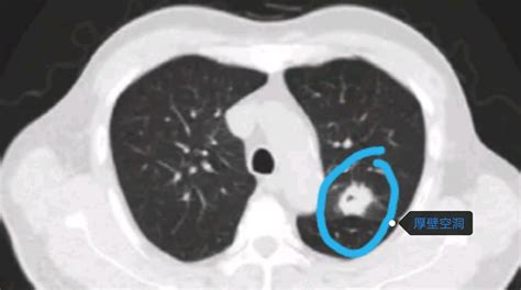 金发光教授：肺癌治疗中「光动力治疗」的作用主要应用于早期中央型肺癌根治治疗……浅谈指南对于PDT的推荐和变迁丨CACP 2022-头条-呼吸界