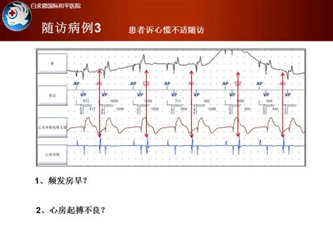 心脏起搏器的频率适应原理及其硬件结构_挂云帆