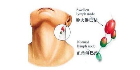 淋巴大全图片