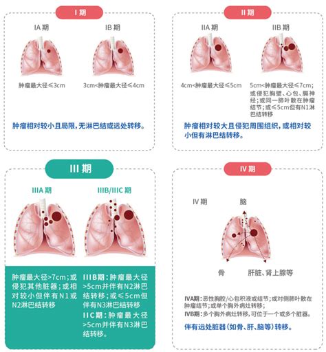 浙江省推进肺癌诊疗一体化中心建设