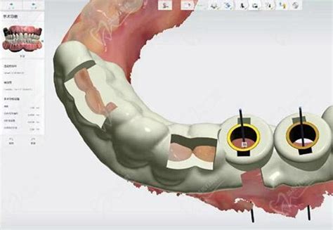 什么是数字化种植牙？相比传统种植牙有啥优势？ - 知乎