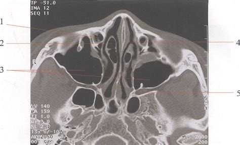 图3—66 上颌窦和气化的中鼻甲-眼耳鼻喉-医学