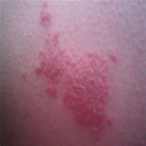 荨麻疹日常生活注意事项有哪些-长春博润皮肤病医院