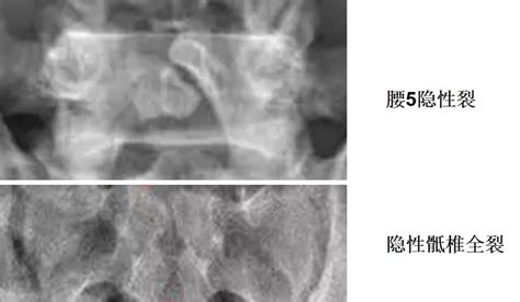 脊柱裂图片