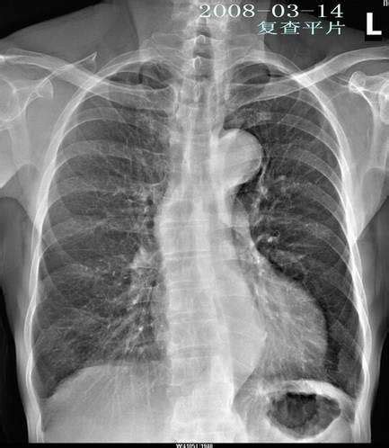 一例表现为双肺多发实变影的免疫功能正常宿主肺隐球菌病-人文-呼吸界