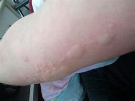 慢性荨麻疹的症状是怎样的_荨麻疹_北京京城皮肤医院(北京医保定点机构)
