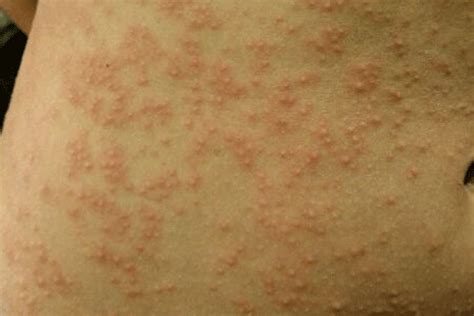 夏天出汗过多容易引发皮疹，还有这些因素也可能会引发皮疹__凤凰网