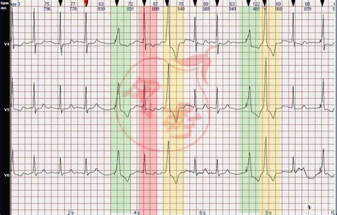 心电图图例分析：心房颤动，室性早搏，VVI起搏，假性融合波 - 爱爱医医学网