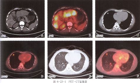 PET-CT查出肝癌肺转移案例_肿瘤_医生在线