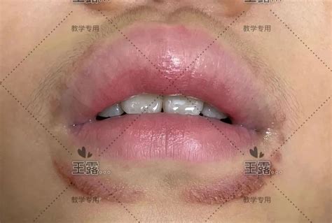 女性口周皮炎图片