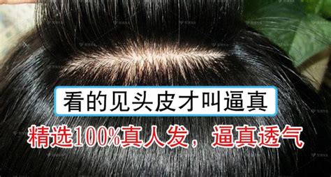 头发种植价格费用一般需要多少钱（现身说法） - 知乎