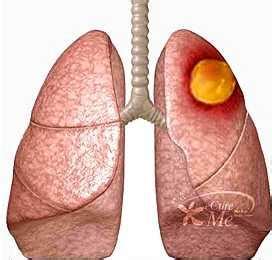 第19个“全球肺癌关注月”宣教活动-遵义医科大学附属医院