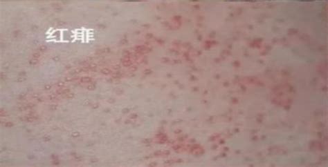 新生儿常见皮疹有哪些？_专题_新闻频道_云南网