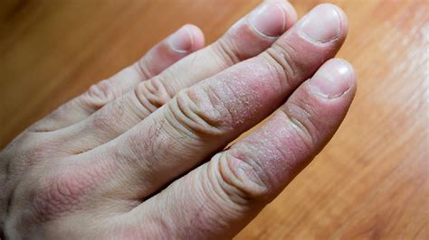 手指水泡型湿疹,手指水泡(第3页)_大山谷图库