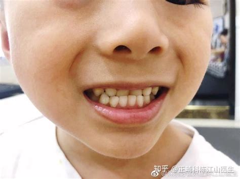 深圳牙齿矫正#陈江山医生聊矫正：乳牙期，替牙期阶段 - 知乎