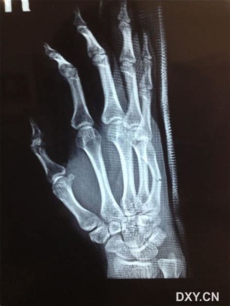 左手第五掌骨骨折 复位了好几天了 手还痛_第二人生