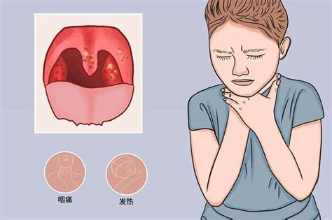 喉咙很痛怎么办咽口水都好痛（感染新冠后，为什么咽口水像吞刀片？缓解咽痛，用这4招或管用） | 说明书网