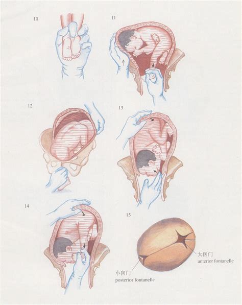 手转胎头术-妇产科手术-医学