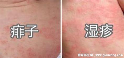 常见湿疹分为五种类型图片，汗疱疹/钱币疱疹/干性湿疹(都瘙痒) — 神奇养生网