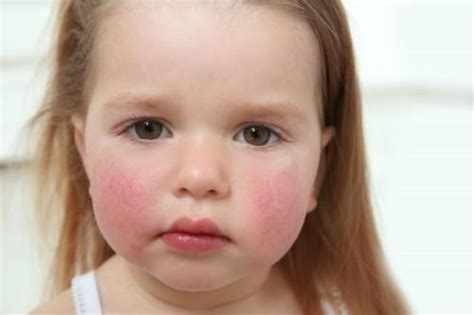 儿童皮肤过敏是什么原因导致的 - 育儿知识