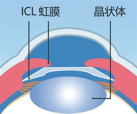 ICL晶体植入 - 成都新视界眼科医院