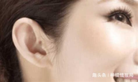 耳朵有痣图解图片