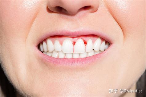 【刷牙出血是恶癌先兆】【图】刷牙出血是恶癌先兆吗 4个方法帮你轻松治疗牙龈出血(3)_伊秀健康|yxlady.com