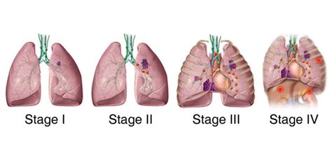 2021版晚期肺癌治疗指南更新|肺癌|治疗|晚期|放疗|症状|-健康界
