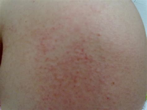 手臂上大腿上的鸡皮疙瘩（胳膊和大腿上有好多像鸡皮疙瘩一样的东西）