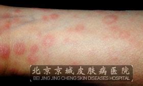 皮肤梅毒图片_梅毒_北京京城皮肤医院(北京医保定点机构)