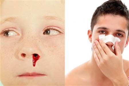 【图】鼻子出血是什么原因 这几点都是它流血的罪魁祸首_鼻子_伊秀美容网|yxlady.com