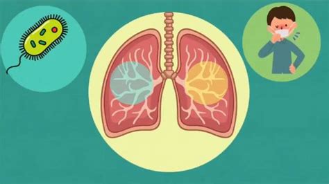 肺癌早期是有信号的……|肺癌_新浪新闻