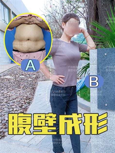 腹壁修复专家余文林：40岁宝妈产后大肚腩，腹壁修复+乳房悬吊术后年轻十岁！ - 知乎