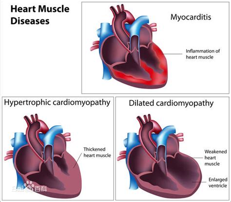 扩张型心肌病，扩张型心肌病的临床表现