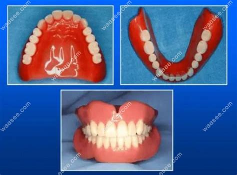全口义齿的固位原理包括:空气压力以及良好的咬合关系 - 口腔资讯 - 牙齿矫正网