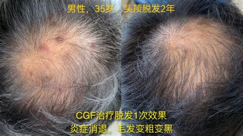 CGF再生技术：促毛发新生，修复面部过敏，还你魅力容颜！-浙北明州医院