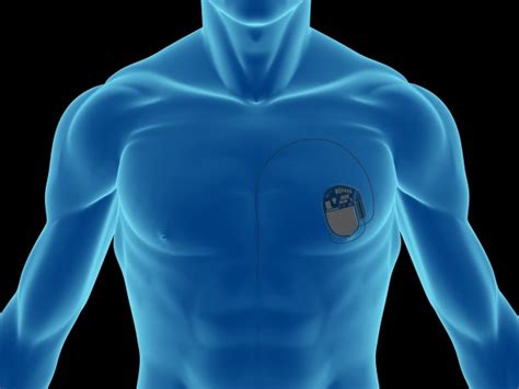 科技改变医疗：新型心脏起搏器让患者受益_环球医疗器械网