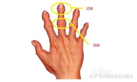 先天性手指屈曲畸形 - 微医（挂号网）