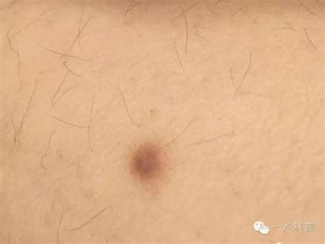 皮下纤维瘤图片