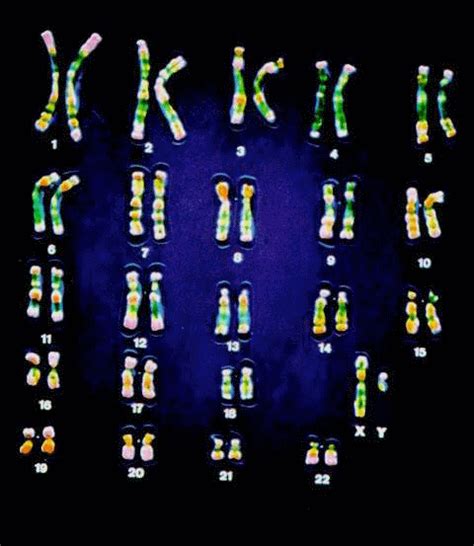 徐州发现的染色体异常核型，是世界第二例同源染色体平衡易位 - 全程导医网