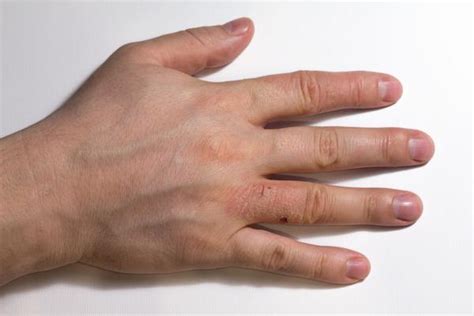 【手指长小水泡很痒】【图】手指长小水泡很痒是怎么回事 提醒你治疗的4个注意事项_伊秀健康|yxlady.com