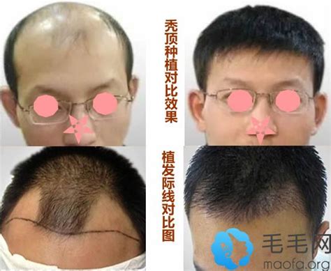 郑州科发源植发怎么样 男士种植头发5个月后成功摆脱秃顶_郑州大麦微针植发植发案例 - 毛毛网