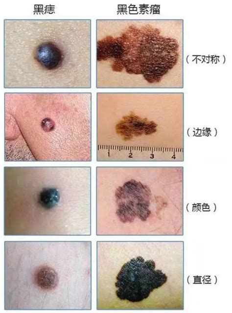 正常痣的样子图片
