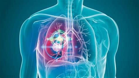 一文看懂肺癌的分类、病症和治疗方案 - 知乎