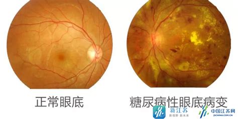 专家提醒：警惕糖尿病带来的失明风险_中国江苏网