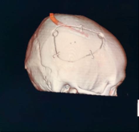 高龄大量脑出血患者的三连刀手术丨 颅脑创伤-神经重症病例周刊（98期） - 脑医汇 - 神外资讯 - 神介资讯