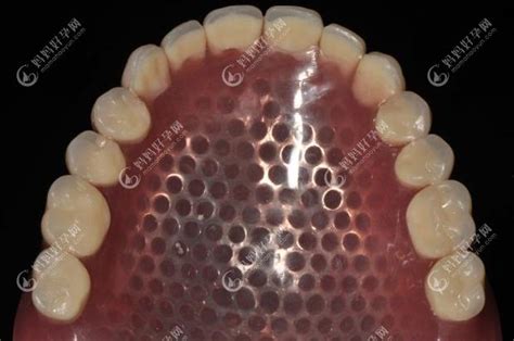 种植氧化锆全瓷牙-浙江玛立义齿有限公司