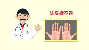 【手上长小水泡】【图】手上长小水泡的危害 汗疱疹是皮肤湿疹(2)_伊秀健康|yxlady.com