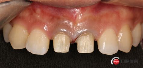 前牙美容 牙冠延长术 颜值提升-通海微笑口腔 普丽萍的博客-KQ88口腔博客